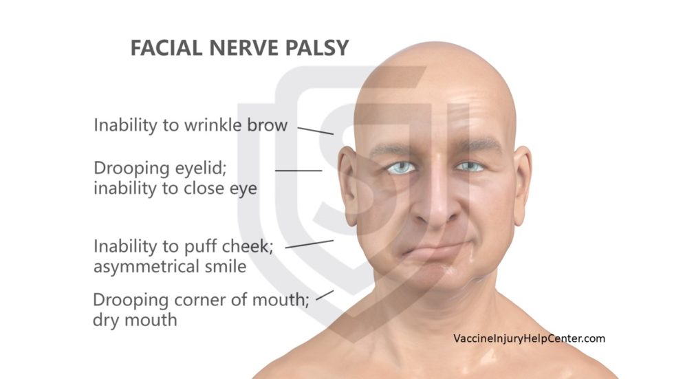 Bell's Palsy and Vaccines - Vaccine Injury Help Center